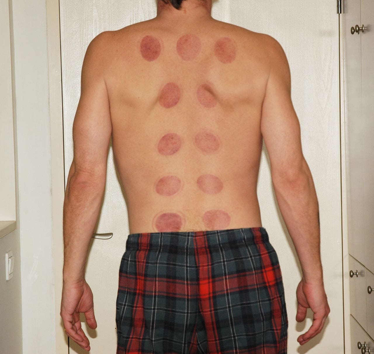 Acupuncture: The Key to Relieving Chronic Fatigue Syndrome?